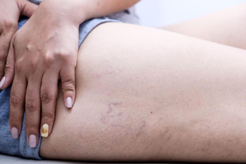 Tackling Spider Veins Holistically