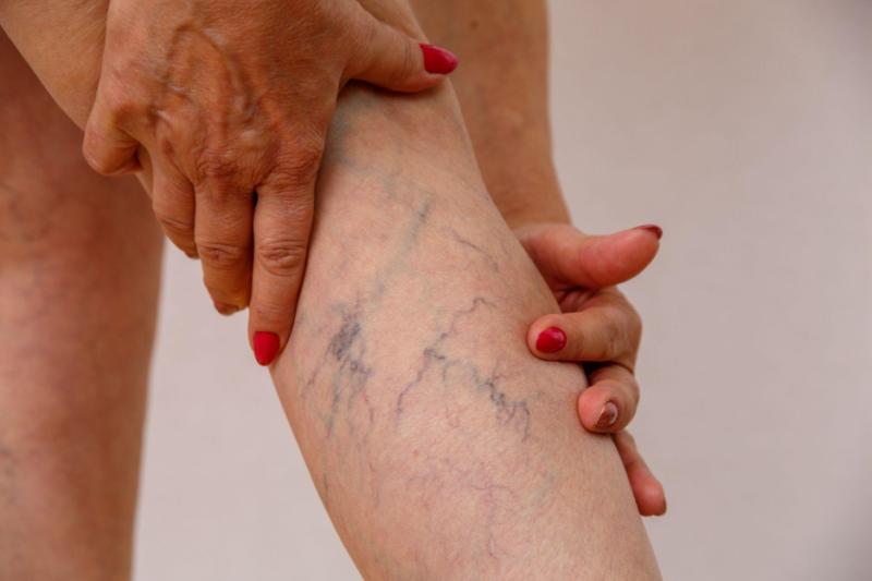 Spider Veins - Myths, Realities, and Potential Dangers