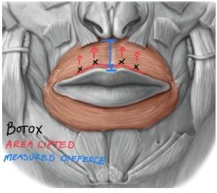 The lip flip with Botox 